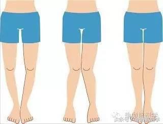 o型腿矫正的正确方法图片,矫正o型腿最有效动作图解(2)