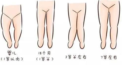 x型腿矫正训练方法小孩,小孩x型腿矫正方法图解(3)
