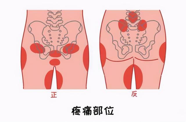 耻骨是哪个部位图片图解,孕妇耻骨痛部位图片(2)