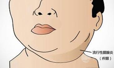 腮腺炎怎么治疗最好,仙人掌腮腺炎治疗最好的方法(1)