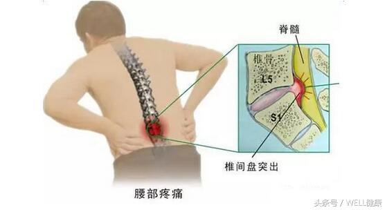 腰突渐渐好转的征兆,腰突屁股疼腿疼的最快缓解方法(1)