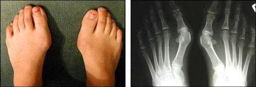 大脚骨手术是局麻还是全麻,做完大脚骨手术的感觉(3)