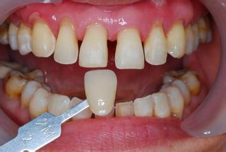 树脂牙对身体有危害吗,补树脂牙好还是全瓷好(1)