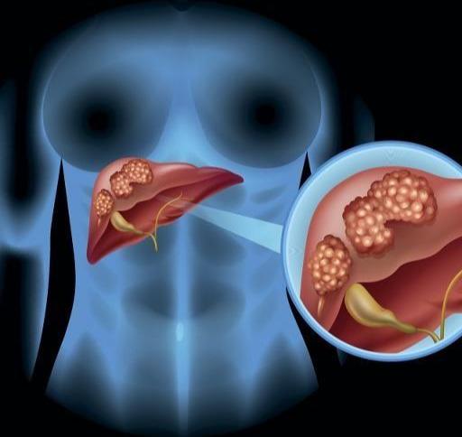 甲胎蛋白多少是肝癌,甲胎蛋白多少以上是肝癌(1)