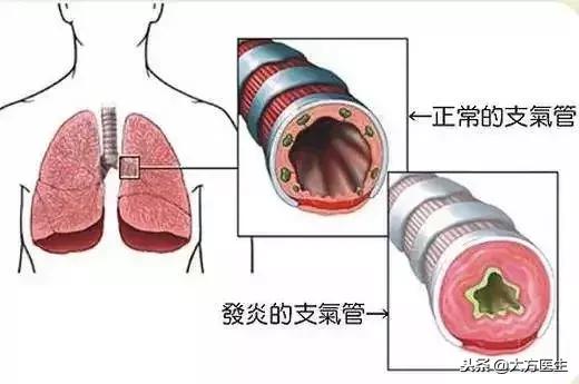 肺炎和支气管炎的区别,小孩肺炎和支气管炎的区别(1)