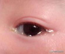 小孩眼睛无故流眼水怎么办,儿童眼睛有眼水怎么回事(1)