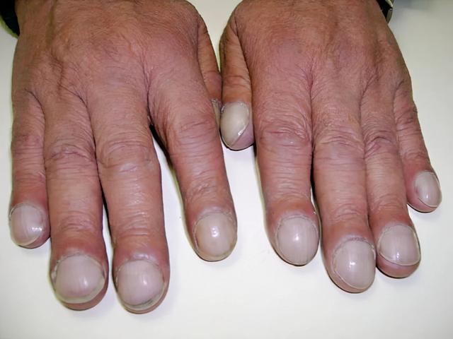 手指胀是什么病的预兆,手指头为什么会莫名发胀(2)