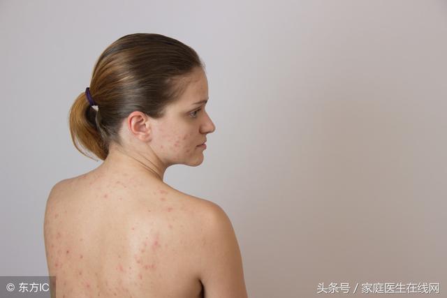 背上长痘痘是身体哪里出问题了,背上和身上长痘痘是什么原因(1)