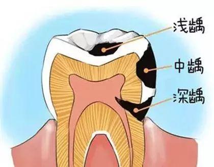 牙缝磨了洞补牙能维持多久,牙缝补牙后一般能维持几年(1)