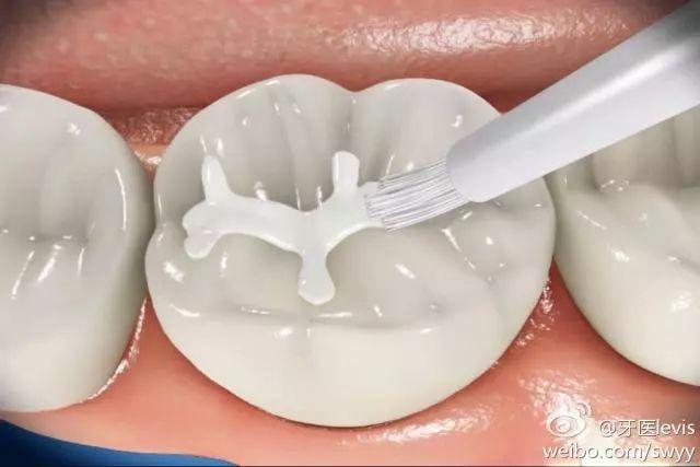 牙缝磨了洞补牙能维持多久,牙缝补牙后一般能维持几年(3)