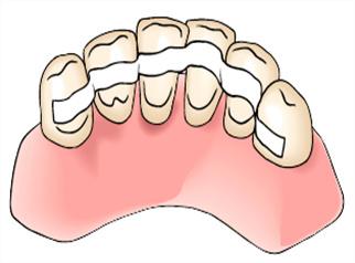 牙齿松动固定术图解,牙齿松动固定修复前后图片(1)