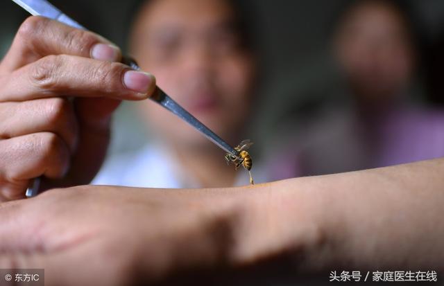 蜂针的正确治疗方法,蜂针怎么处理好得快(3)