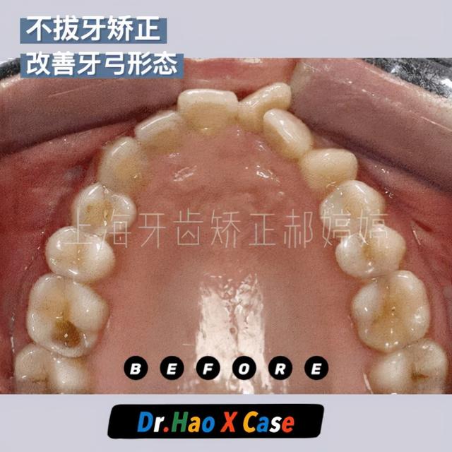 扩弓矫正牙齿的方法,所有牙齿矫正都要扩弓(1)