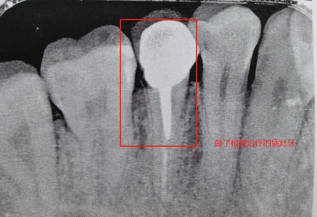 补牙后做牙套的利弊,根管治疗10年没做牙套(3)