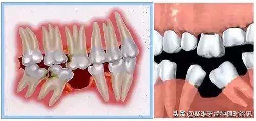 缺牙不补一般几年邻牙会倾斜,缺牙不补后几年牙就长歪斜了(3)