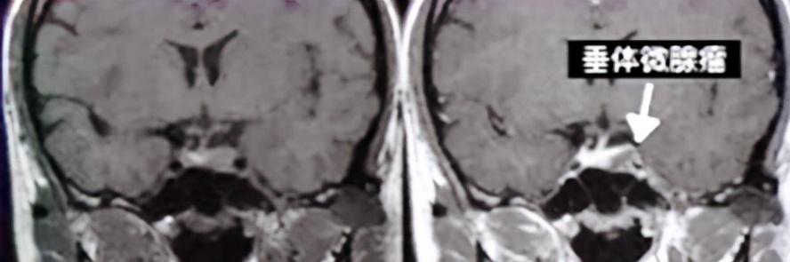 头部磁共振能查出什么,头晕查脑ct还是脑核磁(2)