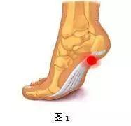 一只脚后跟疼,一只脚后跟疼警惕癌症(4)