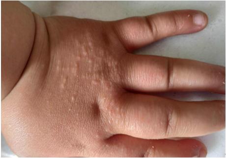手足口疹子消退顺序,手足口好转的征兆(8)