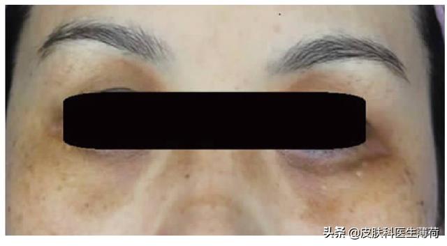 去除先天性黑眼圈方法,先天性黑眼圈太重怎么消除(3)