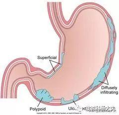 皮革胃是指什么胃,什么是皮革胃怎么治疗(2)
