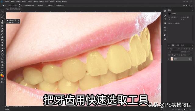 做满口牙材料教学视频,做全口牙的全部过程视频(3)