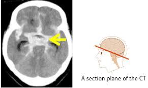 蛛网膜在大脑哪个部位图解,蛛网膜在大脑哪个位置(3)