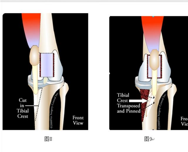 怎么判断膝关节脱臼,膝关节自然脱臼是怎么了(2)