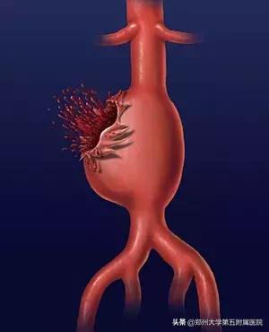 腹主动脉瘤前兆,腹主动脉瘤能活多久(2)