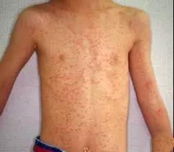 普通皮疹的特点,各类皮疹类型及特征(4)