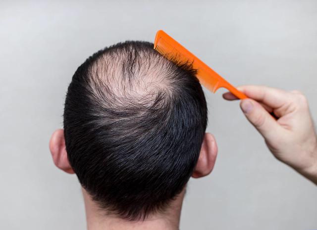 胱氨酸片对脂溢性脱发有效果吗,胱氨酸片男性吃副作用(1)