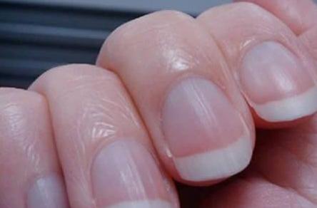 指甲竖纹多吃什么食物好得快,哪种指甲是癌症(1)