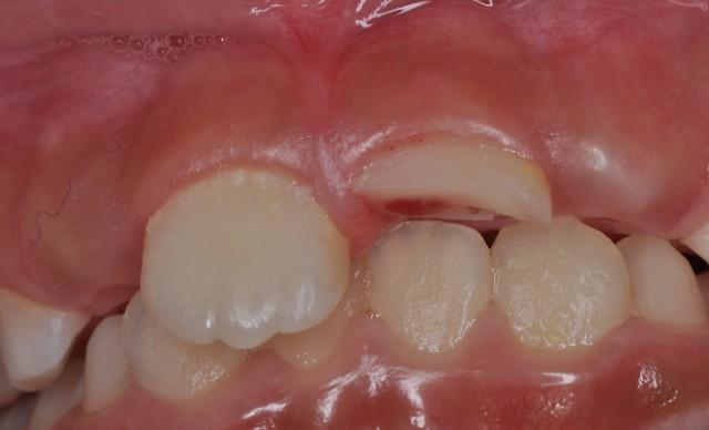 断牙处理方式,断牙能自己恢复吗(1)