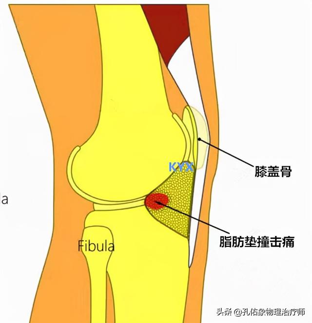 膝盖疼痛位置图,膝盖疼痛图解大全(8)
