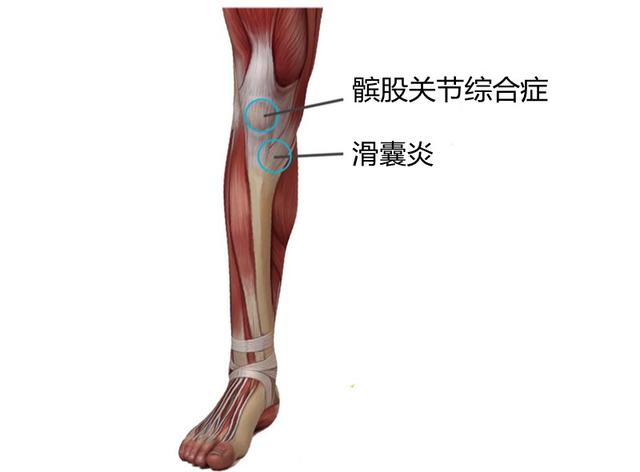 膝关节15种疼痛讲解,膝关节疾病的五种症状(3)