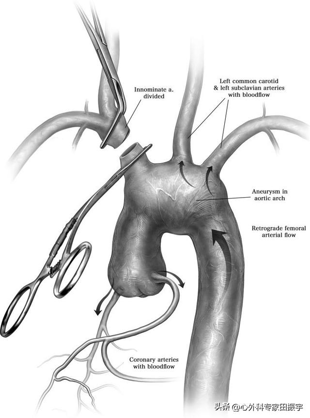 右主动脉弓手术费用,双主动脉弓是不是一定要手术(3)