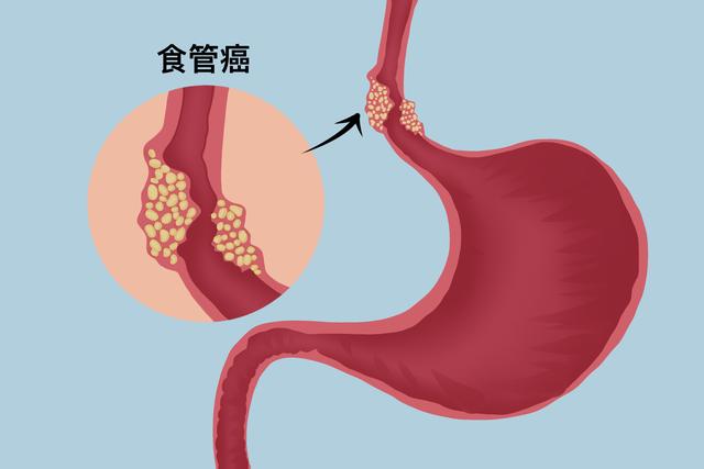 食管癌的典型症状是,判断食道癌最简单方法(2)