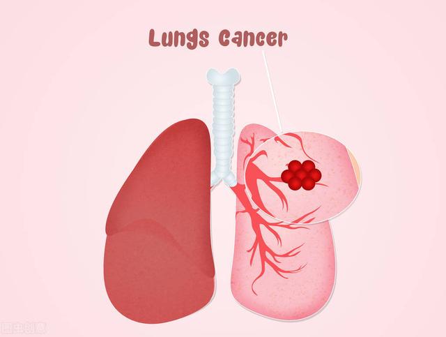 胸痛怎么排除是肺癌,肺癌胸痛位置示意图(1)