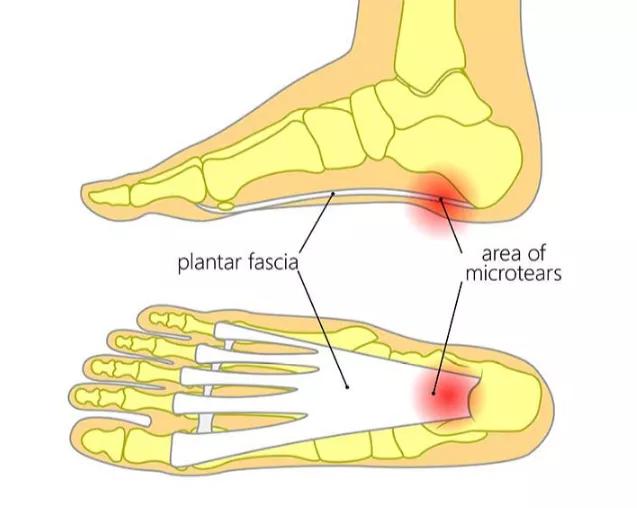 前脚掌痛是大病前兆,前脚掌痛的最快解决办法(3)