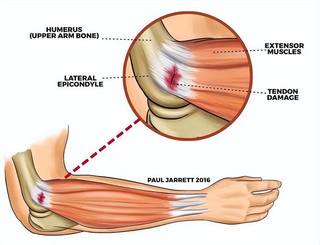 小臂肌肉一握拳就疼痛,左小臂疼痛要警惕三种病(3)