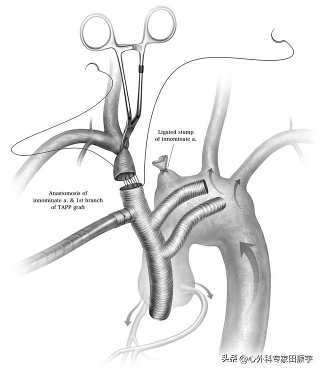 右主动脉弓手术费用,双主动脉弓是不是一定要手术(4)