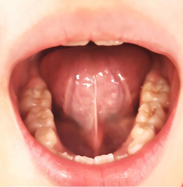 割舌筋的危害,儿童剪舌筋后要住院吗(2)