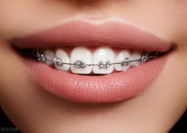陶瓷牙套和金属牙套哪个好,陶瓷牙套效果图(3)