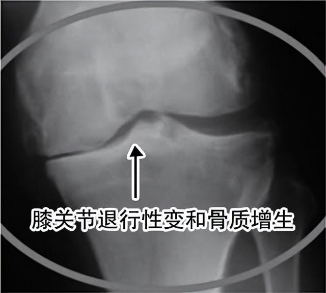 左膝盖疼痛用什么办法治好,膝盖疼痛怎么治最好最有效(4)