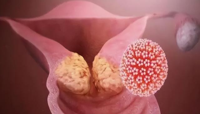 宫颈癌排液是什么感觉,女人hpv最明显的征兆(3)