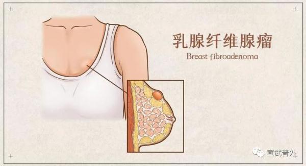 乳腺导管瘤什么原因造成的,乳腺导管瘤最严重会有什么后果(3)