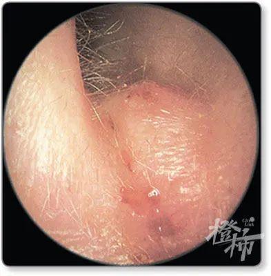耳朵软骨凹槽里长痘痘按起来痛,耳朵软骨凹槽里长痘痘但不痛(2)