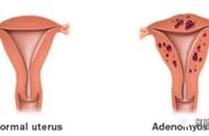 肌腺增生最好治疗方法（42岁腺肌症最好治疗方法）