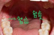 拔智齿的危害有多大（拔了智齿脸凹陷图片）