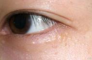 脂肪粒和眼霜的关系（脂肪粒是过度用眼霜造成的吗）