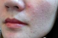 脸上长痘是雌激素多还是雄激素多（脸上长痘痘和雌激素有关系吗）